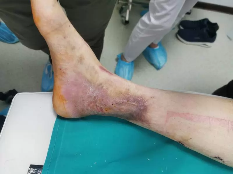 endoskopska operacija vena na nogama