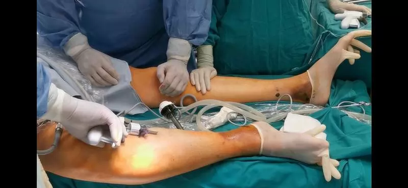 Operacija vena na nogama