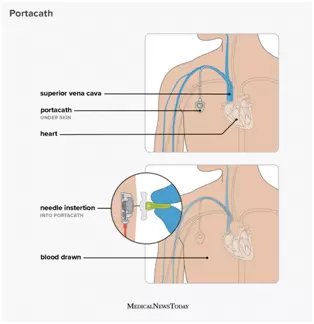 portacath - Port za Hemioterapiju